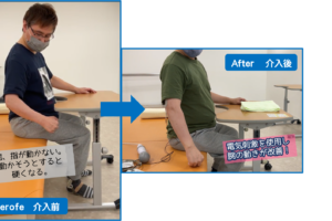 電気刺激を使用し、腕の動きが改善!