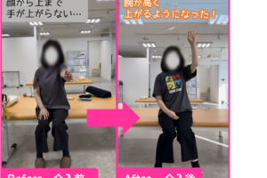 電気刺激と反復練習で、左手での動作が可能に!