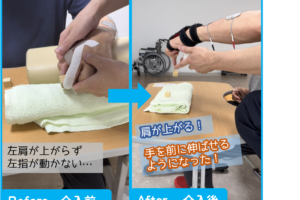 川平法+電気刺激で、肩を上げて手を伸ばす動作が可能に!