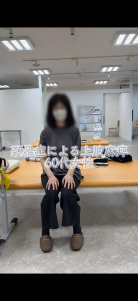 上肢麻痺のリハビリ#shorts