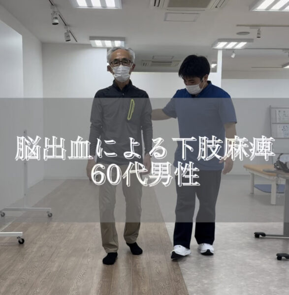 脳出血による下肢麻痺#shorts