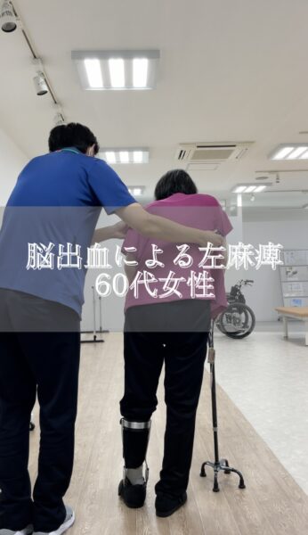 脳出血による左麻痺　60代女性#shorts