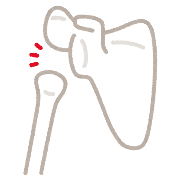意外と多い肩の亜脱臼